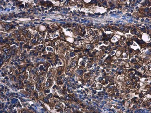 STAT2 antibody [C2C3], C-term detects STAT2 protein at cytoplasm in human endometrial carcinoma by immunohistochemical analysis. Sample: Paraffin-embedded human endometrial carcinoma. STAT2 antibody [C2C3], C-term (GTX103117) diluted at 1:500. 
 Antigen Retrieval: Citrate buffer, pH 6.0, 15 min