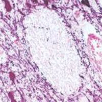 TH staining of human mid-brain. Note cytoplasmic staining of catecholaminergic cells and their processes. Paraffin section (Peroxidase substrate: nickel DAB,Counterstain: eosin).