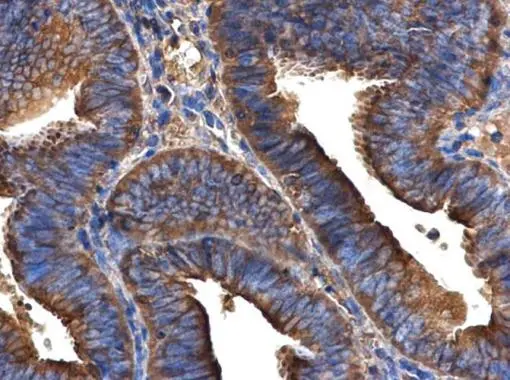 ARFIP2 antibody [N1C2] detects ARFIP2 protein at cytoplasm in human endometrial cancer by immunohistochemical analysis. Sample: Paraffin-embedded human endometrial cancer. ARFIP2 antibody [N1C2] (GTX104241) diluted at 1:500. 
 Antigen Retrieval: Citrate buffer, pH 6.0, 15 min
