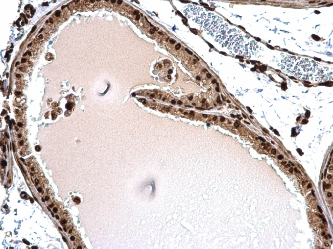 Histone H1.3 antibody detects Histone H1.3 protein at nucleus on mouse prostate by immunohistochemical analysis. Sample: Paraffin-embedded mouse prostate. Histone H1.3 antibody (GTX104481) dilution: 1:500.
Antigen Retrieval: Trilogy? (EDTA based, pH 8.0) buffer, 15min Histone H1.3 antibody detects Histone H1.3 protein at nucleus on mouse prostate by immunohistochemical analysis. Sample: Paraffin-embedded mouse prostate. Histone H1.3 antibody (GTX104481) dilution: 1:500.
Antigen Retrieval: Trilogy? (EDTA based, pH 8.0) buffer, 15min