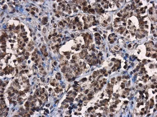 ERK2 antibody [N1], N-term detects ERK2 protein at cytoplasm and nucleus in human oral carcinoma by immunohistochemical analysis. Sample: Paraffin-embedded human oral carcinoma. ERK2 antibody [N1], N-term (GTX104613) diluted at 1:500. 
 Antigen Retrieval: Citrate buffer, pH 6.0, 15 min