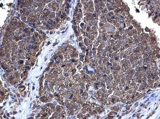CDC2 antibody [N1],N-term detects CDC2 protein at cytoplasm on human breast carcinoma by immunohistochemical analysis.