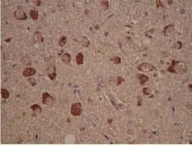 IHC-P analysis of granular lesions in the hippocampus of a patient with Alzheimer's disease tissue using GTX10877 Casein Kinase 1 delta antibody.
