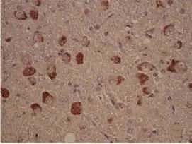 IHC-P analysis of granular lesions in the hippocampus of a patient with Alzheimers disease tissue using GTX10877 Casein Kinase 1 delta antibody. IHC-P analysis of granular lesions in the hippocampus of a patient with Alzheimers disease tissue using GTX10877 Casein Kinase 1 delta antibody.