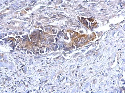 BCL10 antibody [N1C3] detects BCL10 protein at cytoplasm on human colon carcinoma by immunohistochemical analysis. Sample: Paraffin-embedded human colon carcinoma. BCL10 antibody [N1C3] (GTX109159) diluted at 1:500. 
 Antigen Retrieval: Trilogy? (EDTA based, pH 8.0) buffer, 15min