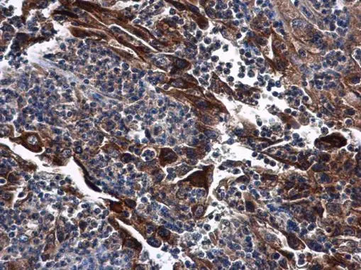 DNase I antibody [N1C3] detects DNase I protein at cytoplasm in human endometrial carcinoma by immunohistochemical analysis. Sample: Paraffin-embedded human endometrial carcinoma. DNase I antibody [N1C3] (GTX109306) diluted at 1:500. 
 Antigen Retrieval: Citrate buffer, pH 6.0, 15 min