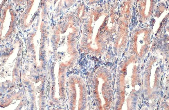CD74 antibody [N1N2], N-term detects CD74 protein at cytoplasm by immunohistochemical analysis. Sample: Paraffin-embedded human lung cancer. CD74 stained by CD74 antibody [N1N2], N-term (GTX110477) diluted at 1:500. Antigen Retrieval: Citrate buffer, pH 6.0, 15 min
