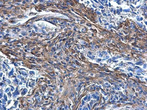 COL1A1 antibody [N1N2], N-term detects COL1A1 protein at secreted on human lung carcinoma by immunohistochemical analysis. Sample: Paraffin-embedded human lung carcinoma. COL1A1 antibody [N1N2], N-term (GTX112731) diluted at 1:500. 
 Antigen Retrieval: Trilogy? (EDTA based, pH 8.0) buffer, 15min