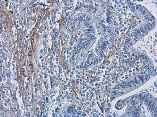 COL1A1 antibody [N1N2], N-term detects secreted COL1A1 protein in human colon cancer by immunohistochemical analysis. Sample: Paraffin-embedded human colon cancer. COL1A1 antibody [N1N2], N-term (GTX112731) diluted at 1:500. 
 Antigen Retrieval: Citrate buffer, pH 6.0, 15 min