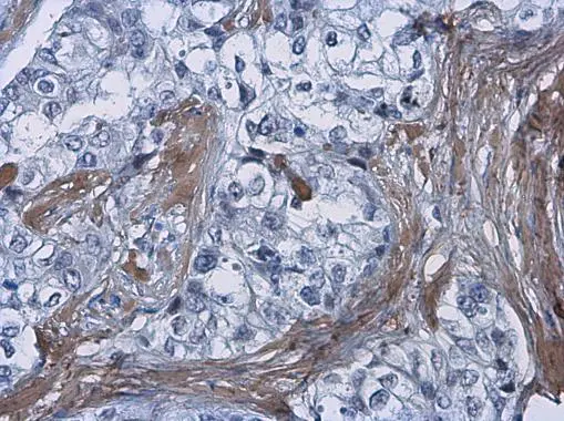 COL1A1 antibody [N1N2], N-term detects secreted COL1A1 protein in human breast carcinoma by immunohistochemical analysis. Sample: Paraffin-embedded human breast carcinoma. COL1A1 antibody [N1N2], N-term (GTX112731) diluted at 1:500. 
 Antigen Retrieval: Citrate buffer, pH 6.0, 15 min