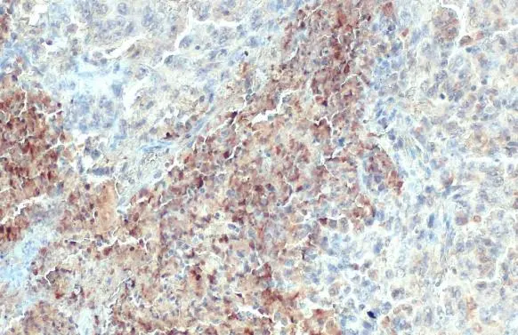C1qA antibody detects secreted C1qA protein by immunohistochemical analysis. Sample: Paraffin-embedded human lung cancer. C1qA stained by C1qA antibody (GTX112883) diluted at 1:500. Antigen Retrieval: Citrate buffer, pH 6.0, 15 min