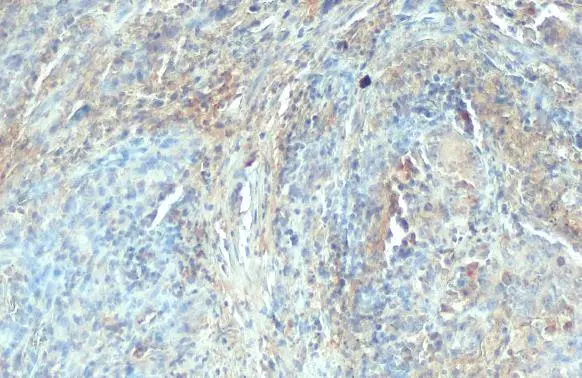 C1qA antibody detects secreted C1qA protein by immunohistochemical analysis. Sample: Paraffin-embedded human lung cancer. C1qA stained by C1qA antibody (GTX112883) diluted at 1:500. Antigen Retrieval: Citrate buffer, pH 6.0, 15 min