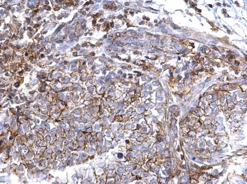 CD44 antibody [N1N2], N-term detects CD44 protein at cell membrane on human breast carcinoma by immunohistochemical analysis. Sample: Paraffin-embedded human breast carcinoma. CD44 antibody [N1N2], N-term (GTX112893) diluted at 1:500. 
 Antigen Retrieval: Trilogy? (EDTA based, pH 8.0) buffer, 15min