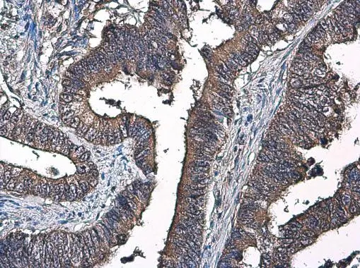 Factor IX antibody [N3C3] detects Factor IX protein at cytoplasm in human colon cancer by immunohistochemical analysis. Sample: Paraffin-embedded human colon cancer. Factor IX antibody [N3C3] (GTX113689) diluted at 1:250.