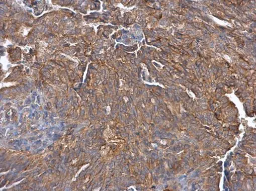 Cullin 7 antibody [C2C3], C-term detects Cullin 7 protein at cytoplasm in human endometrial carcinoma by immunohistochemical analysis. Sample: Paraffin-embedded human endometrial carcinoma. Cullin 7 antibody [C2C3], C-term (GTX113906) diluted at 1:500. 
 Antigen Retrieval: Citrate buffer, pH 6.0, 15 min