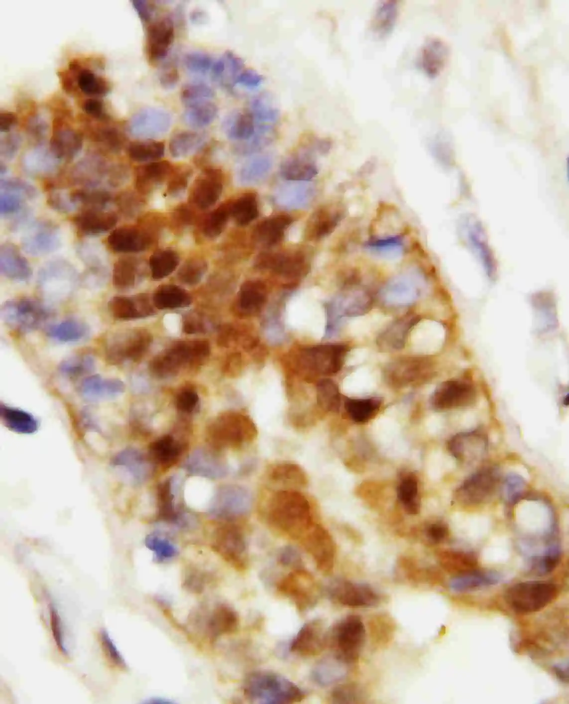 IHC-P analysis of human mammary cancer tissue using GTX11573 Hsp70 antibody. Antigen retireval : Heat mediated antigen retrieval was performed in citrate buffer (pH6, epitope retrieval solution) for 20 mins Dilution : 1microg/ml