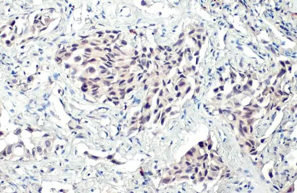 BRD1 antibody detects BRD1 protein at nucleus by immunohistochemical analysis. Sample: Paraffin-embedded human lung cancer. BRD1 stained by BRD1 antibody (GTX115758) diluted at 1:500. Antigen Retrieval: Citrate buffer, pH 6.0, 15 min