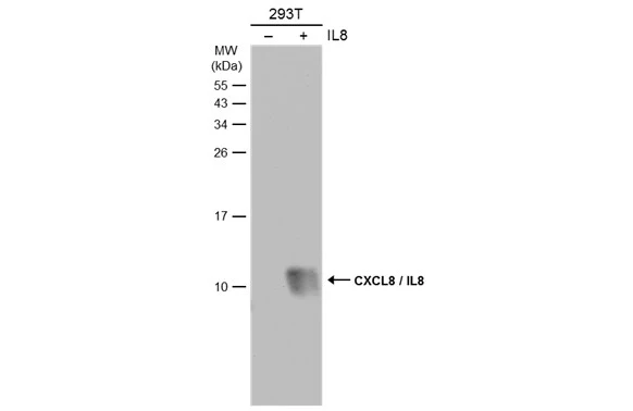 CXCL8 / IL8 antibody detects CXCL8 / IL8 protein at cytosol on human gastric cancer by immunohistochemical analysis. Sample: Paraffin-embedded gastric cancer. CXCL8 / IL8 antibody (GTX115959) Antigen Retrieval: Trilogy? (EDTA based,pH 8.0) buffer,15min