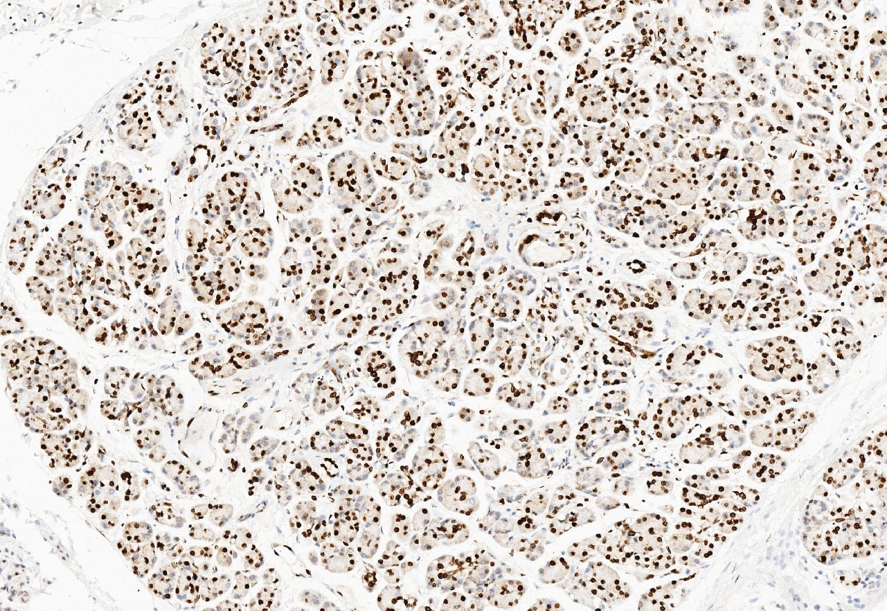 IHC-P analysis of human pancreas cancer tissue using GTX11617 TNFAIP1 antibody. Antigen retireval : Heat mediated antigen retrieval was performed in citrate buffer (pH6, epitope retrieval solution) for 20 mins Dilution : 1microg/ml
