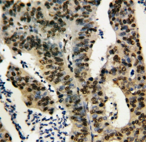 IHC-P analysis of human rectal cancer tissue using GTX11617 TNFAIP1 antibody.