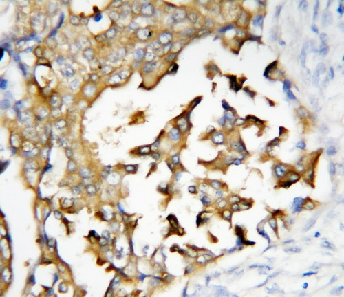 IHC-P analysis of human mammary cancer tissue using GTX11661 Presenilin 2 antibody. IHC-P analysis of human mammary cancer tissue using GTX11661 Presenilin 2 antibody.