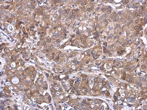 TMPRSS11D antibody detects TMPRSS11D protein at cell membrane and cytoplasm in MCF7 xenograft by immunohistochemical analysis. Sample: Paraffin-embedded MCF7 xenograft. TMPRSS11D antibody (GTX117370) diluted at 1:500. 
 Antigen Retrieval: Citrate buffer, pH 6.0, 15 min