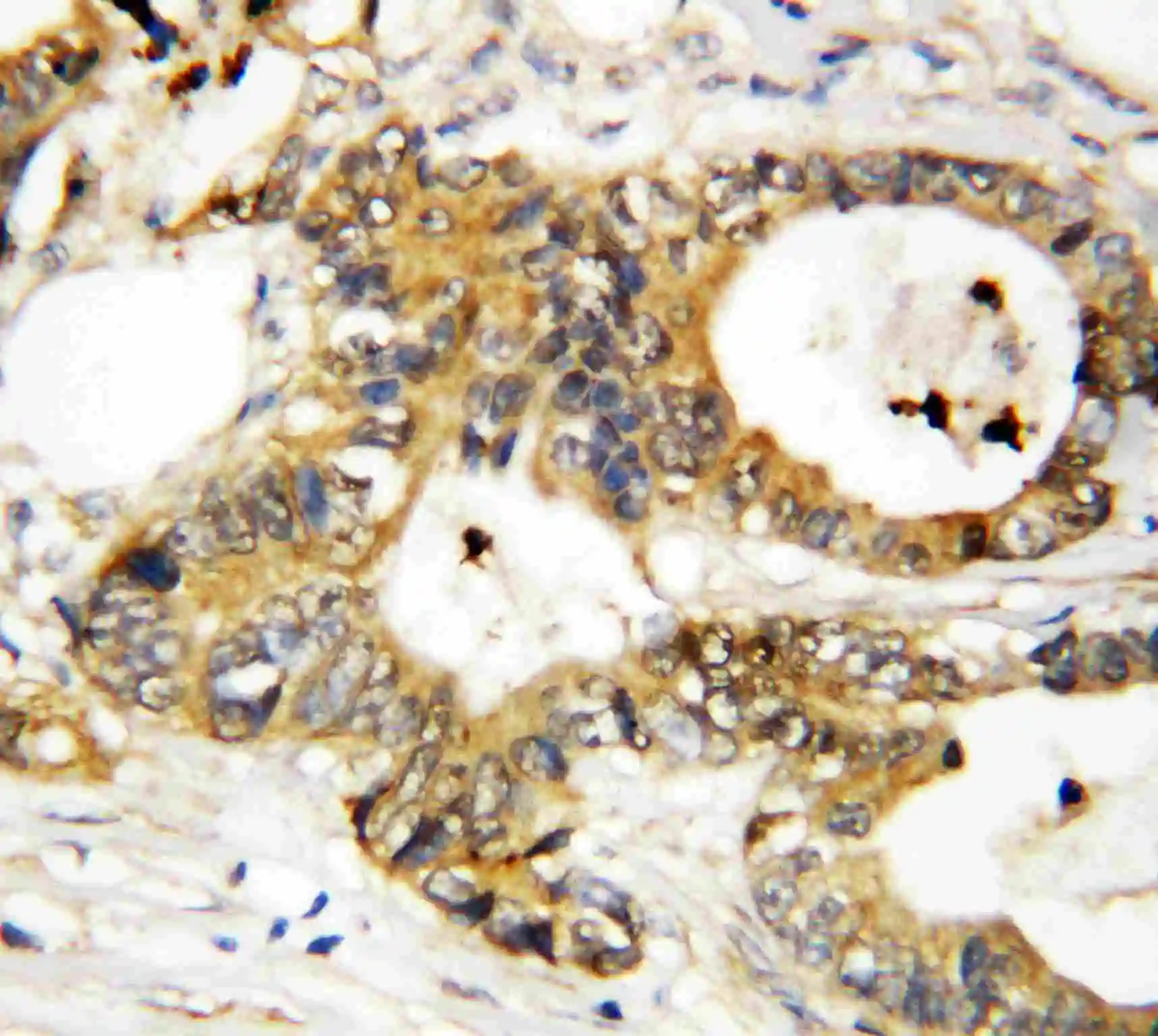 IHC-P analysis of human mammary cancer tissue using GTX11808 Annexin III antibody. IHC-P analysis of human mammary cancer tissue using GTX11808 Annexin III antibody.