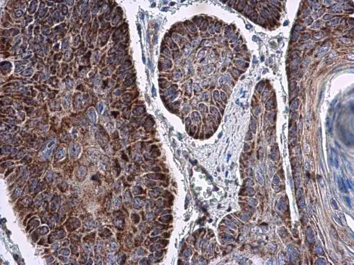 RNF212 antibody detects RNF212 protein at cytoplasm in human esophagus cancer by immunohistochemical analysis. Sample: Paraffin-embedded human esophagus cancer. RNF212 antibody (GTX118251) diluted at 1:500. 
 Antigen Retrieval: Citrate buffer, pH 6.0, 15 min