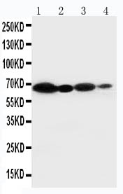 IHC-P analysis of human intestinal cancer tissue using GTX12024 NOX2 / gp91phox antibody. Antigen retrieval: heat-induced antigen retrieval with a citrate buffer (pH6)