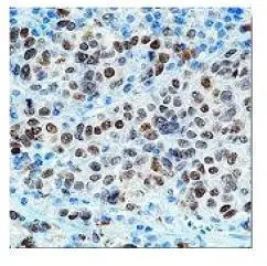 Immunohistochemical staining using microphthalmia antibody on formalin ?xed,paraf?n embedded human melanoma.