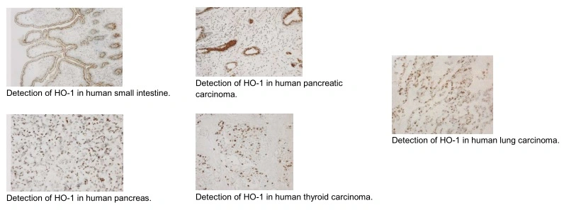 IHC-P analysis of various human cancer tissues using GTX12220 Heme Oxygenase 1 antibody [GTS-1].