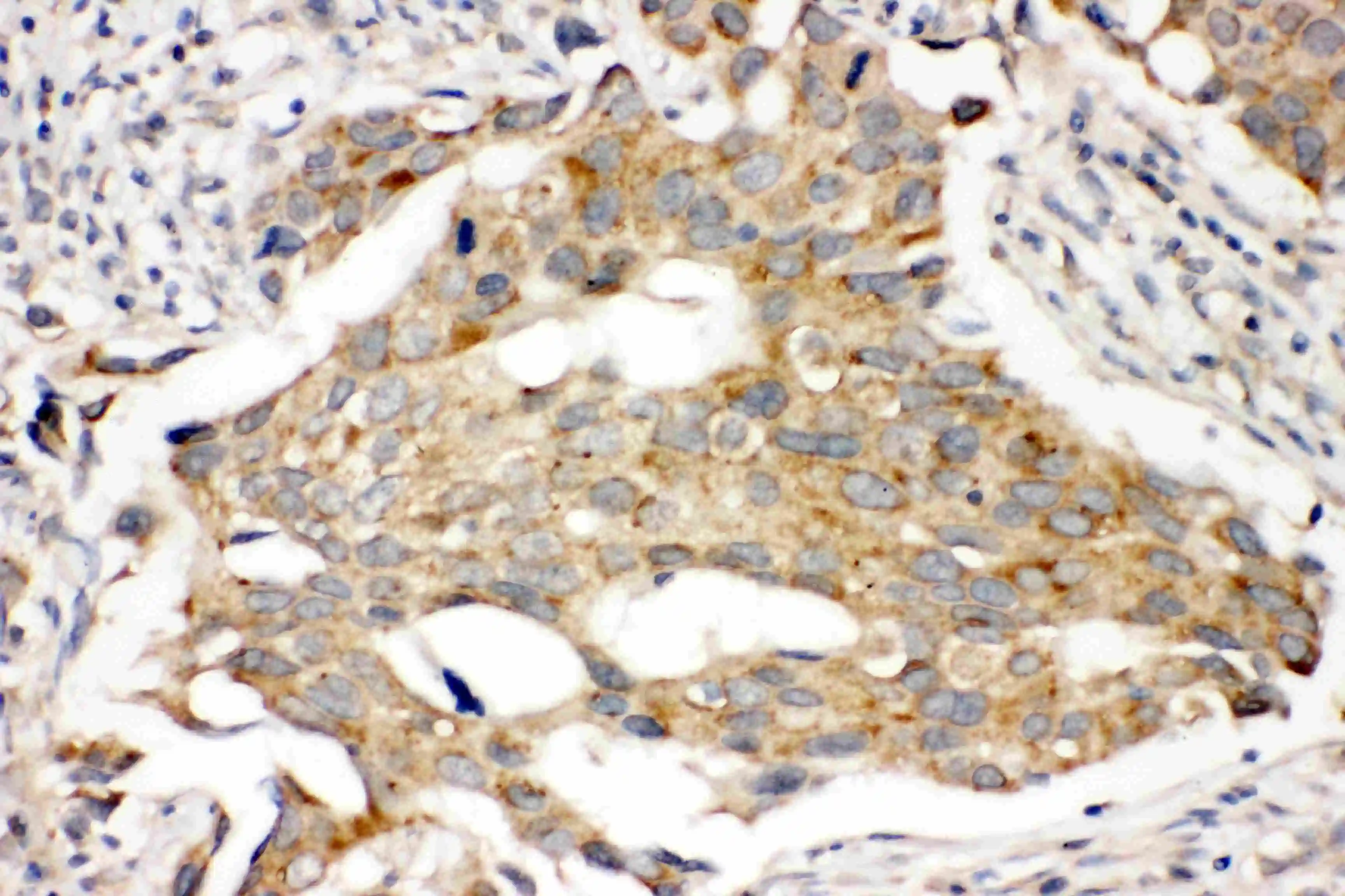 IHC-P analysis of human mammary cancer tissue using GTX12307 Prolactin Receptor antibody. IHC-P analysis of human mammary cancer tissue using GTX12307 Prolactin Receptor antibody.