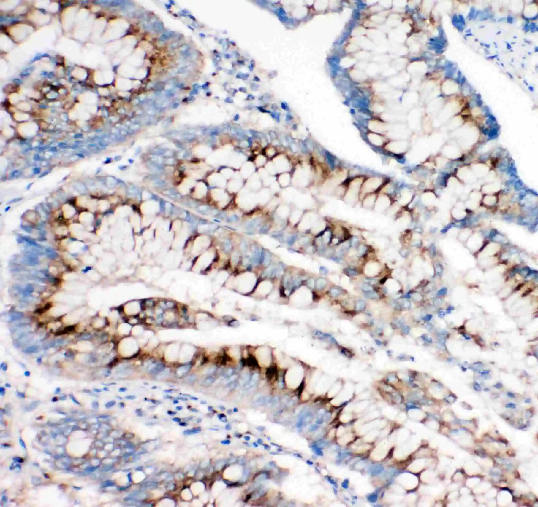 IHC-P analysis of human intestinal cancer tissue using GTX12397 IGF2R antibody.