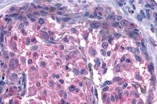 IHC-P analysis of human skin, melanoma tissue using GTX12543 GPR15 antibody. Antigen retrieval : Heat-induced antigen retrieval