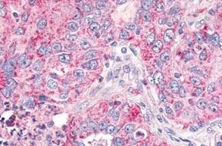 IHC-P analysis of human lung, non-small cell carcinoma tissue using GTX12558 GPR26 antibody. <br>Antigen retrieval : Heat-induced antigen retrieval