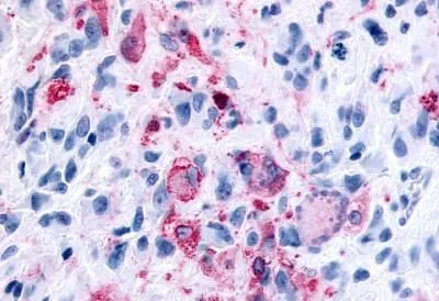 IHC-P analysis of brain, glioblastoma tissue using GTX12571 GPR43 antibody.