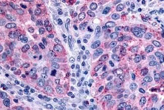 IHC-P analysis of human lung carcinoma tissue using GTX12571 GPR43 antibody. Antigen retrieval : Heat-induced antigen retrieval