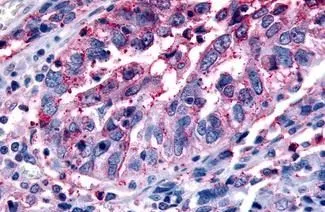 IHC-P analysis of human ovary, carcinoma tissue using GTX12571 GPR43 antibody. Antigen retrieval : Heat-induced antigen retrieval