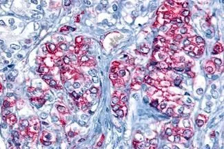 IHC-P analysis of human prostate, carcinoma tissue using GTX12571 GPR43 antibody. Antigen retrieval : Heat-induced antigen retrieval