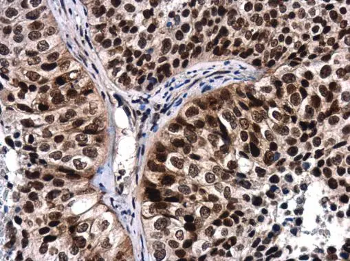 ATR (phospho Thr1989) antibody detects ATR (phospho Thr1989) protein at nucleus in human lung by immunohistochemical analysis. Sample: Paraffin-embedded human lung. ATR (phospho Thr1989) antibody (GTX128145) diluted at 1:250. 
 Antigen Retrieval: Citrate buffer, pH 6.0, 15 min