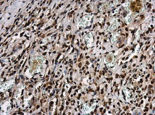 ATR (phospho Thr1989) antibody detects ATR protein at nucleus in human lung cancer by immunohistochemical analysis. Sample: Paraffin-embedded human lung cancer. ATR (phospho Thr1989) antibody (GTX128145) diluted at 1:250. 
 Antigen Retrieval: Citrate buffer, pH 6.0, 15 min