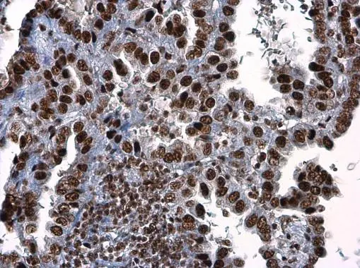 ATR (phospho Thr1989) antibody detects ATR (phospho Thr1989) protein at nucleus in human colon cancer by immunohistochemical analysis. Sample: Paraffin-embedded human colon cancer. ATR (phospho Thr1989) antibody (GTX128145) diluted at 1:250. 
 Antigen Retrieval: Citrate buffer, pH 6.0, 15 min