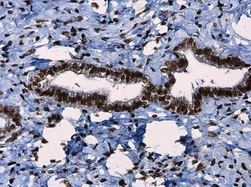 ATR (phospho Thr1989) antibody detects ATR (phospho Thr1989) protein at nucleus in human breast carcinoma by immunohistochemical analysis. Sample: Paraffin-embedded human breast carcinoma. ATR (phospho Thr1989) antibody (GTX128145) diluted at 1:250. 
 Antigen Retrieval: Citrate buffer, pH 6.0, 15 min
