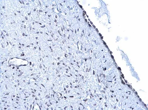ARID1A antibody detects ARID1A protein at nucleus on human endometrial carcinoma by immunohistochemical analysis. Sample: Paraffin-embedded human endometrial carcinoma. ARID1A antibody (GTX129433) diluted at 1:500. 
 Antigen Retrieval: Trilogy? (EDTA based, pH 8.0) buffer, 15min