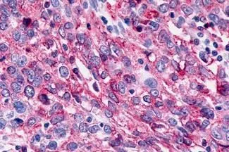 IHC-P analysis of human ovary, carcinoma tissue using GTX12958 CELSR3 antibody. <br>Antigen retrieval : Heat-induced antigen retrieval