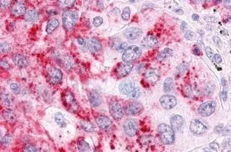IHC-P analysis of human lung, non-small cell carcinoma tissue using GTX12984 ERR alpha antibody. Antigen retrieval : Heat-induced antigen retrieval IHC-P analysis of human lung, non-small cell carcinoma tissue using GTX12984 ERR alpha antibody. Antigen retrieval : Heat-induced antigen retrieval