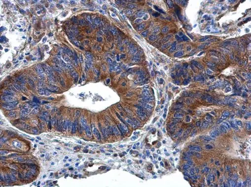 RPL32 antibody detects RPL32 protein at cytoplasm in human colon cancer by immunohistochemical analysis. Sample: Paraffin-embedded human colon cancer. RPL32 antibody (GTX130214) diluted at 1:500.
Antigen Retrieval: Citrate buffer, pH 6.0, 15 min RPL32 antibody detects RPL32 protein at cytoplasm in human colon cancer by immunohistochemical analysis. Sample: Paraffin-embedded human colon cancer. RPL32 antibody (GTX130214) diluted at 1:500.
Antigen Retrieval: Citrate buffer, pH 6.0, 15 min