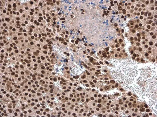DHX9 antibody detects DHX9 protein at cytoplasm and nucleus in CAL 27 xenograft by immunohistochemical analysis. Sample: Paraffin-embedded CAL 27 xenograft. DHX9 antibody (GTX130971) diluted at 1:500. 
 Antigen Retrieval: Citrate buffer, pH 6.0, 15 min