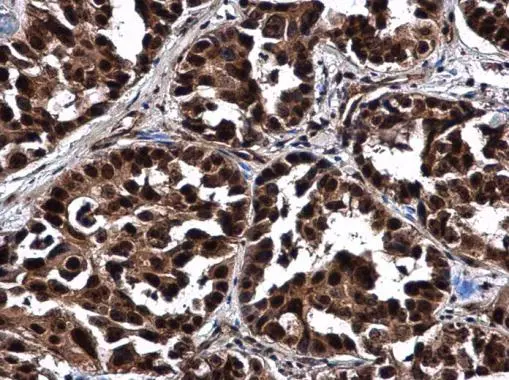 NOP56 antibody detects NOP56 protein at cytoplasm and nucleus in human breast carcinoma by immunohistochemical analysis. Sample: Paraffin-embedded human breast carcinoma. NOP56 antibody (GTX130973) diluted at 1:500. 
 Antigen Retrieval: Citrate buffer, pH 6.0, 15 min