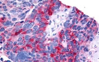 IHC-P analysis of human lung, small cell carcinoma tissue using GTX13113 ROR beta antibody. Antigen retrieval : Heat-induced antigen retrieval